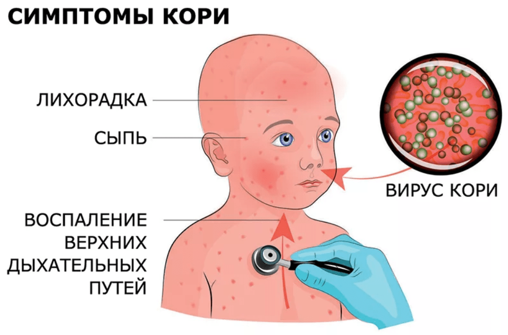 Рисунок сыпь корь